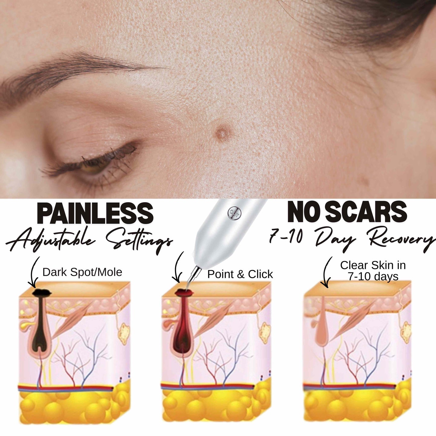 SC Sapphire's Elegant Fibroblast Plasma Pen